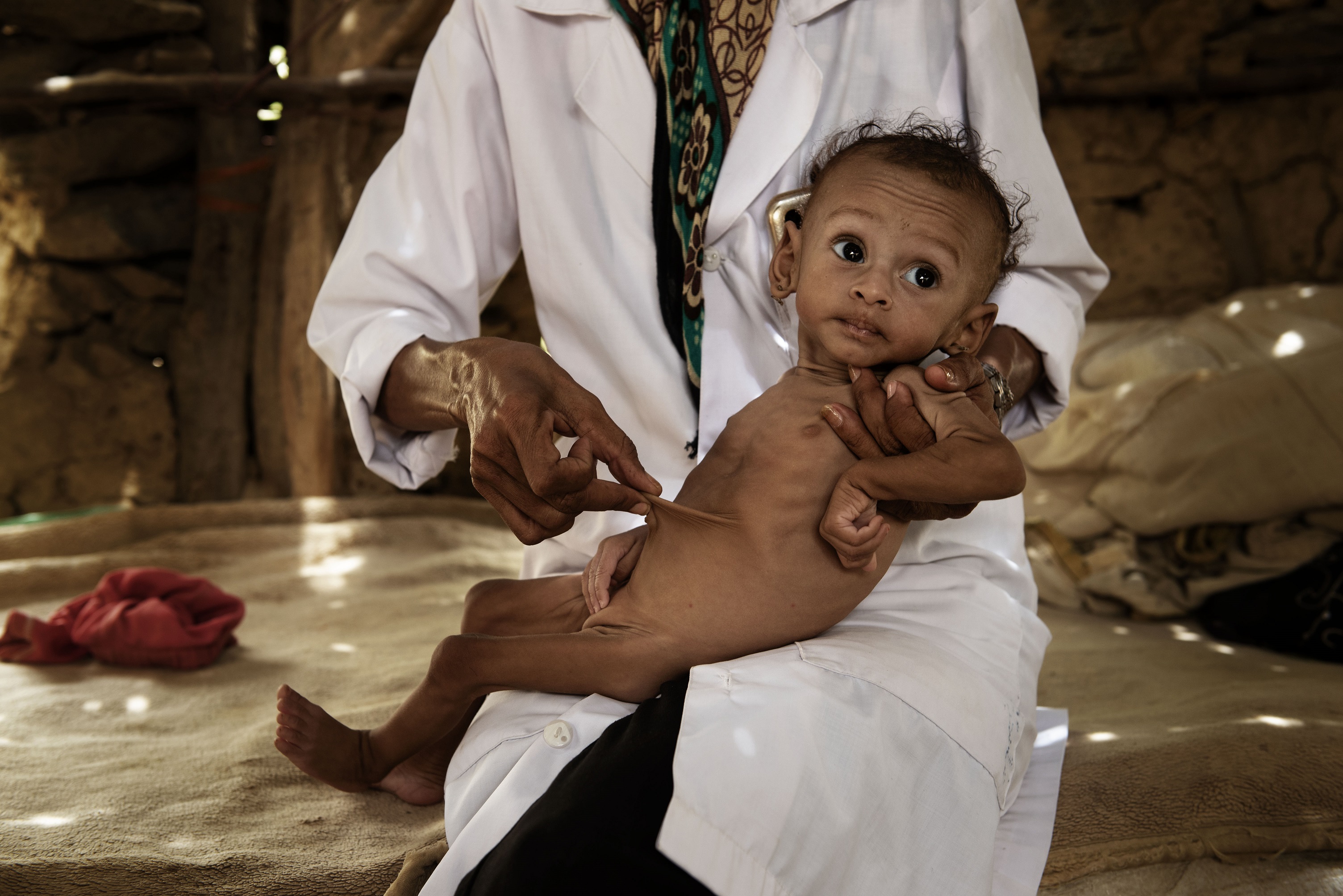 Malnutrition in Yemen