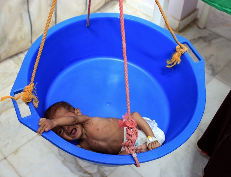 yemen war, malnourished baby